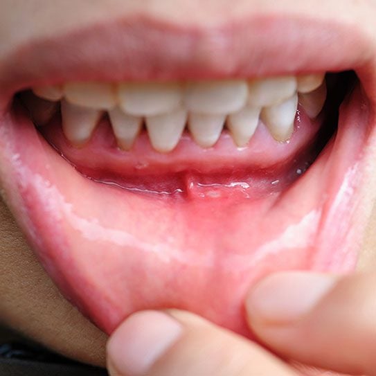 Gum Recession: Causes, Prevention, and Treatment 1 Torrance